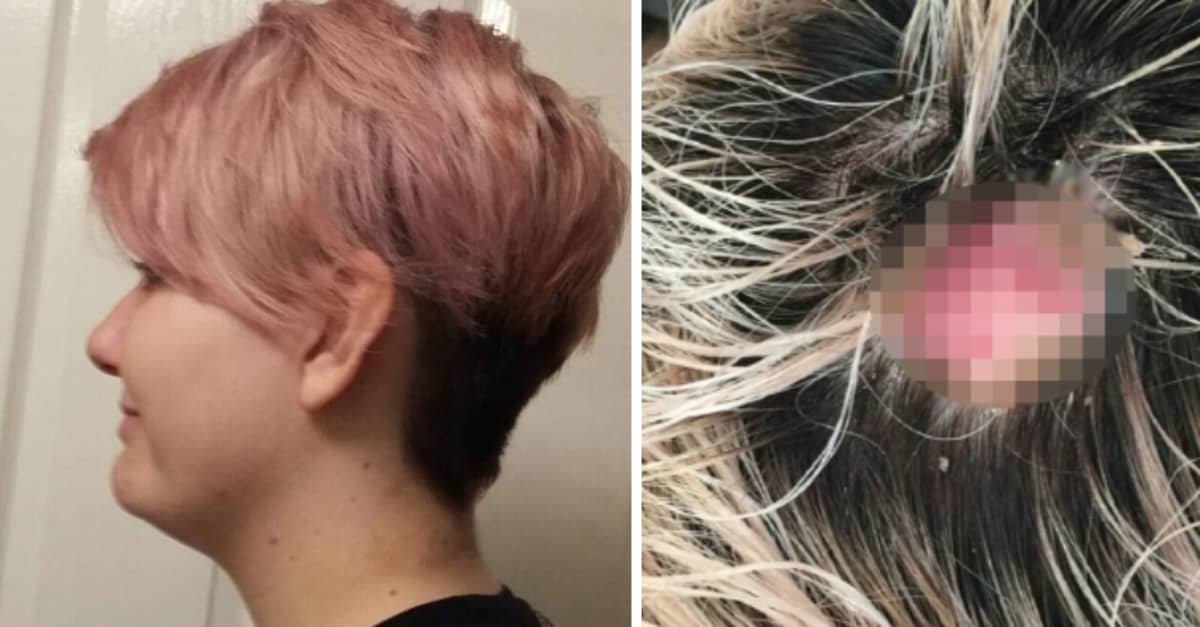 Woman Left With Chemical Burns After Bleaching Her Hair - Tyla