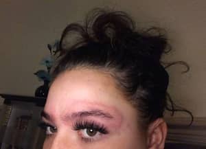 Woman Left Looking Like She'd Been Beat Up After Eyebrow Dye Reaction