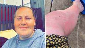Woman Horrified To Learn Little Bumps On Her Skin Are Sun Allergy