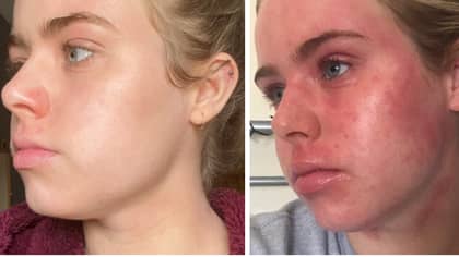 Woman Reveals How She Cleared Up Her Chronic Eczema After 22 Years With £18 Product