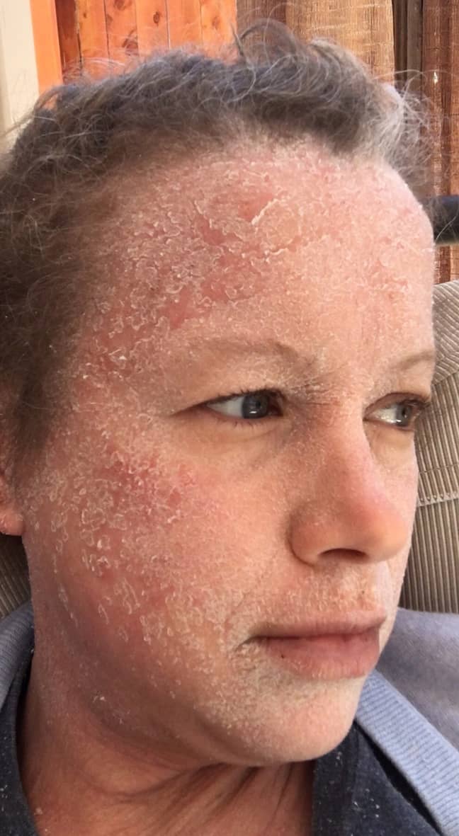 Jennifer Pierce went into withdrawal when she stopped using steroid cream to treat her eczema (Credit: Caters)