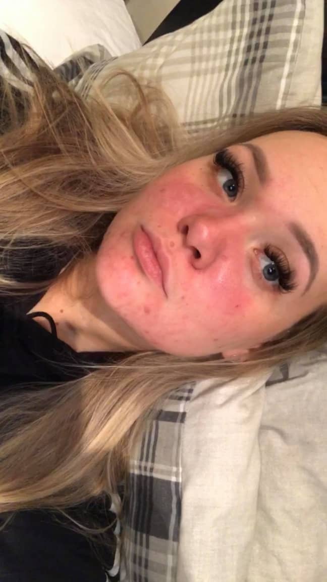 Ellie started a six month treatment on roaccutane in October 2019 (Credit: Kennedy News)