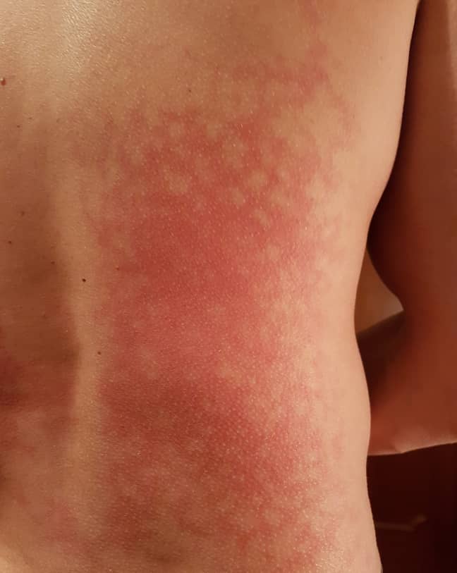 It's not a burn, but a blotchy rash caused by intense heat (Credit: Shutterstock)