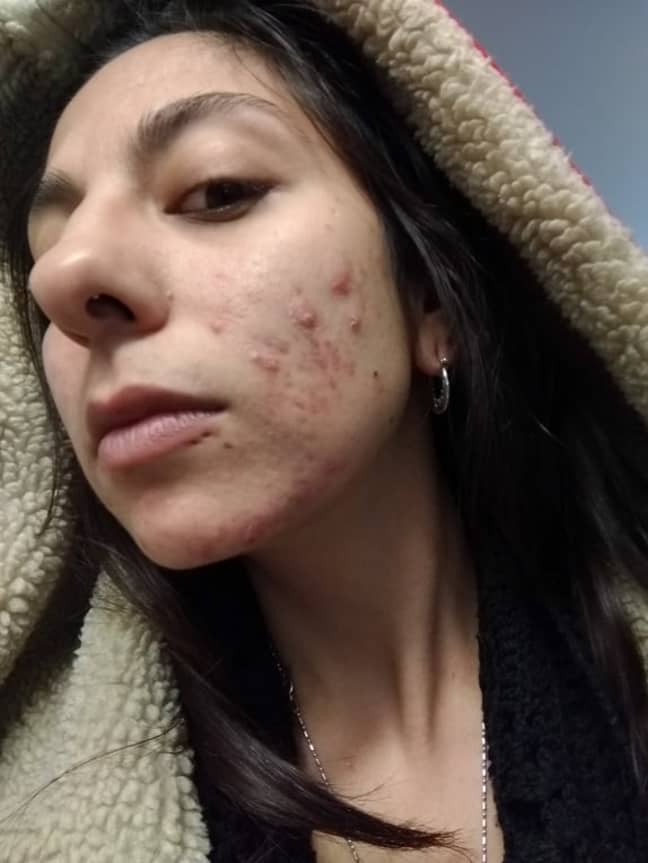 Yasmeen suffered with painful cystic acne (Credit: Caters)
