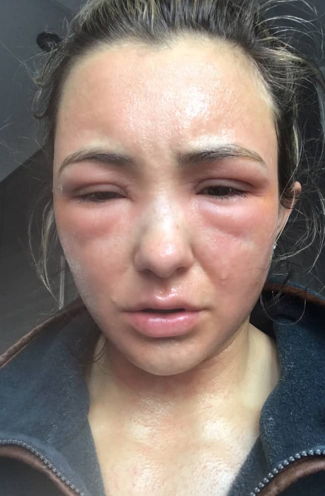 Eden's skin was so sore and swollen that she was mistaken for a victim of domestic abuse (Credit: PA)