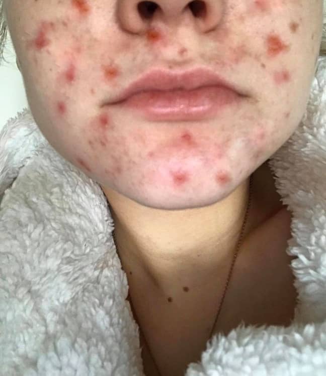 Ellie used to suffer with large, red spots all over her face (Credit: Kennedy News)