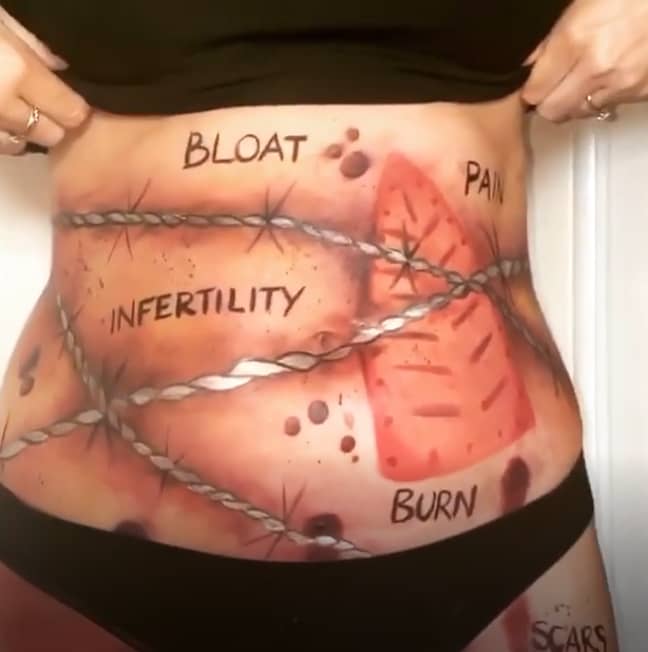 Ruth-Anne etched the symptoms of her endo onto her stomach (Credit: Instagram/ Ruth-Anne)