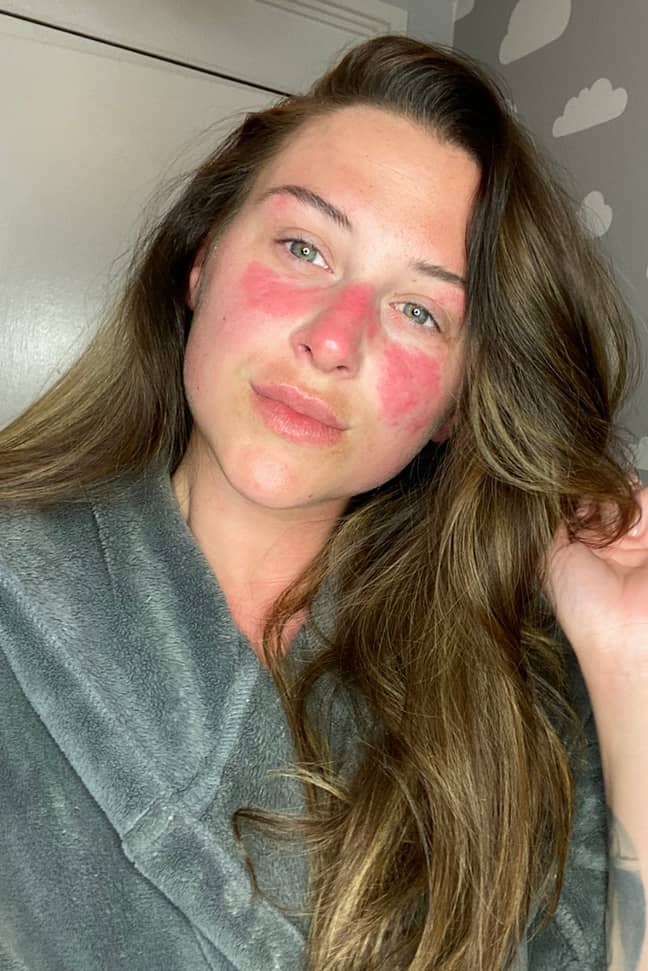 Lauren revealed that she used to feel insecure about the red patches on her face after bullies called her 'snake skin' (Credit: Caters)