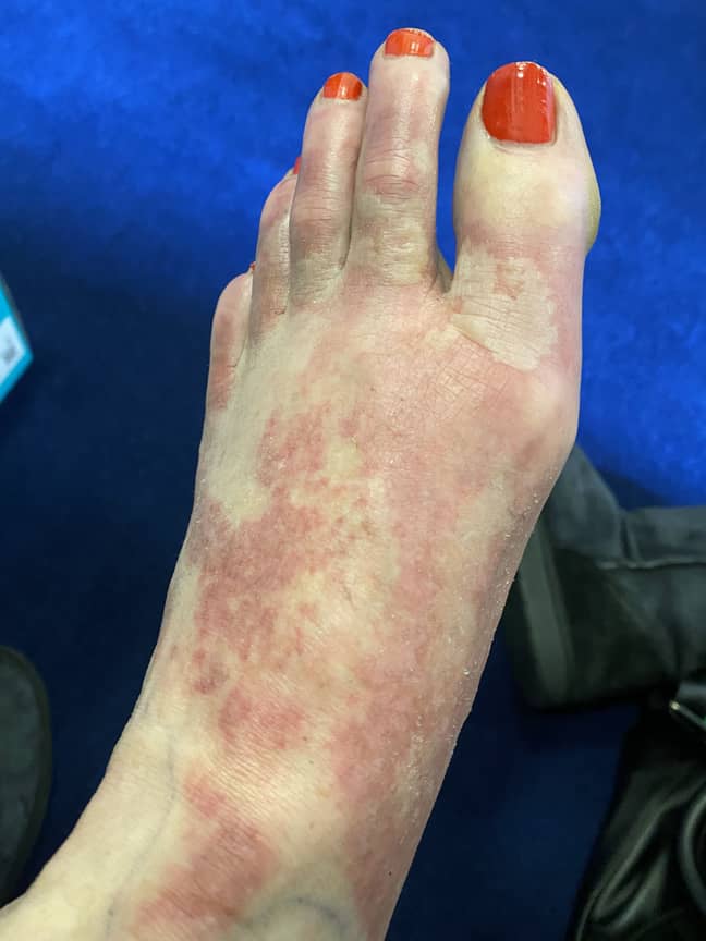 Meegan went to A&amp;E after she suffered a margarita burn following a boat trip (Credit: Kennedy)
