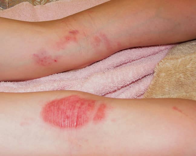 The medical condition comes in a variety of forms and atopic eczema (atopic dermatitis) is the most common type, causing skin to become dry, itchy, cracked and sore. (Credit: Flickr)