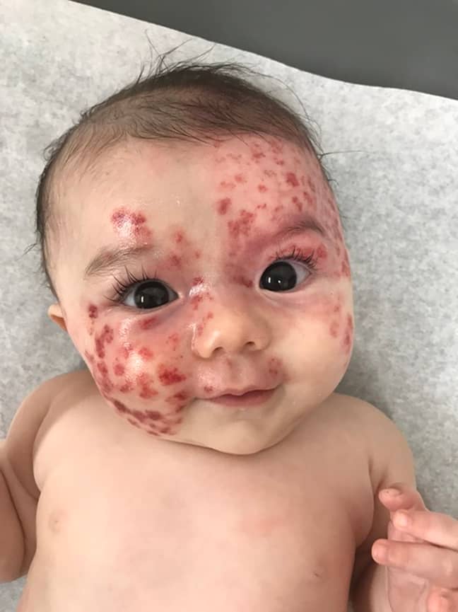 Bianca's birthmark is part of Sturge-Weber syndrome. Credit: Caters