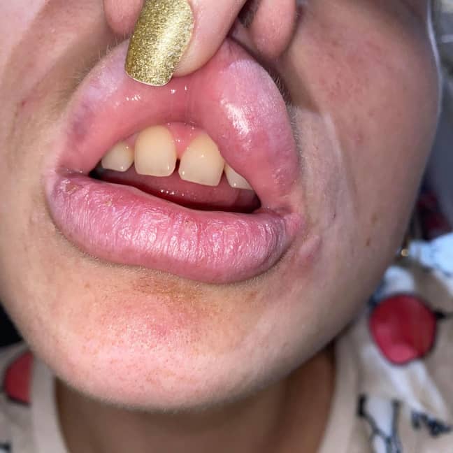  The full-time mum is sharing her ordeal in a bid to urge people to be careful when they get lip fillers (Credit: Kennedy)
