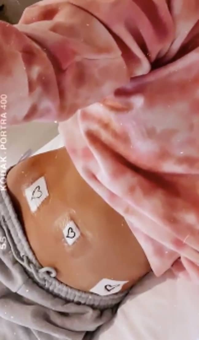 Chrissy showed fans her bandaged stomach (Credit: Instagram/ Chrissy Teigen)