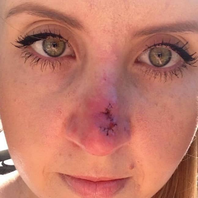 Lauren had Mohs surgery after doctors discovered the cancer had spread deep into her nose (Credit: Lauren Huntriss/ Instagram)