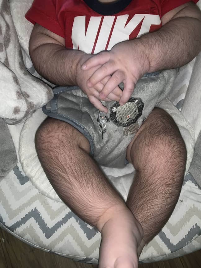 Two weeks after starting the life-saving medication, Mateo's health improved but the unusual side effect left him covered in long, dark body hair. (Credit: Kennedy News and Media)