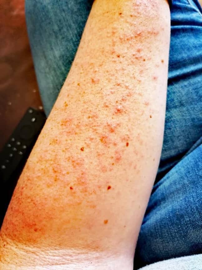 According to the NHS, polymorphic light eruption is skin rash triggered by exposure to UV (Credit: Caters News)
