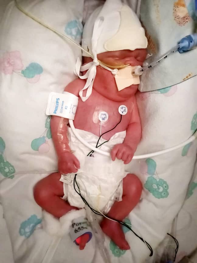 Archie was born 15 weeks premature (Credit: SWNS)