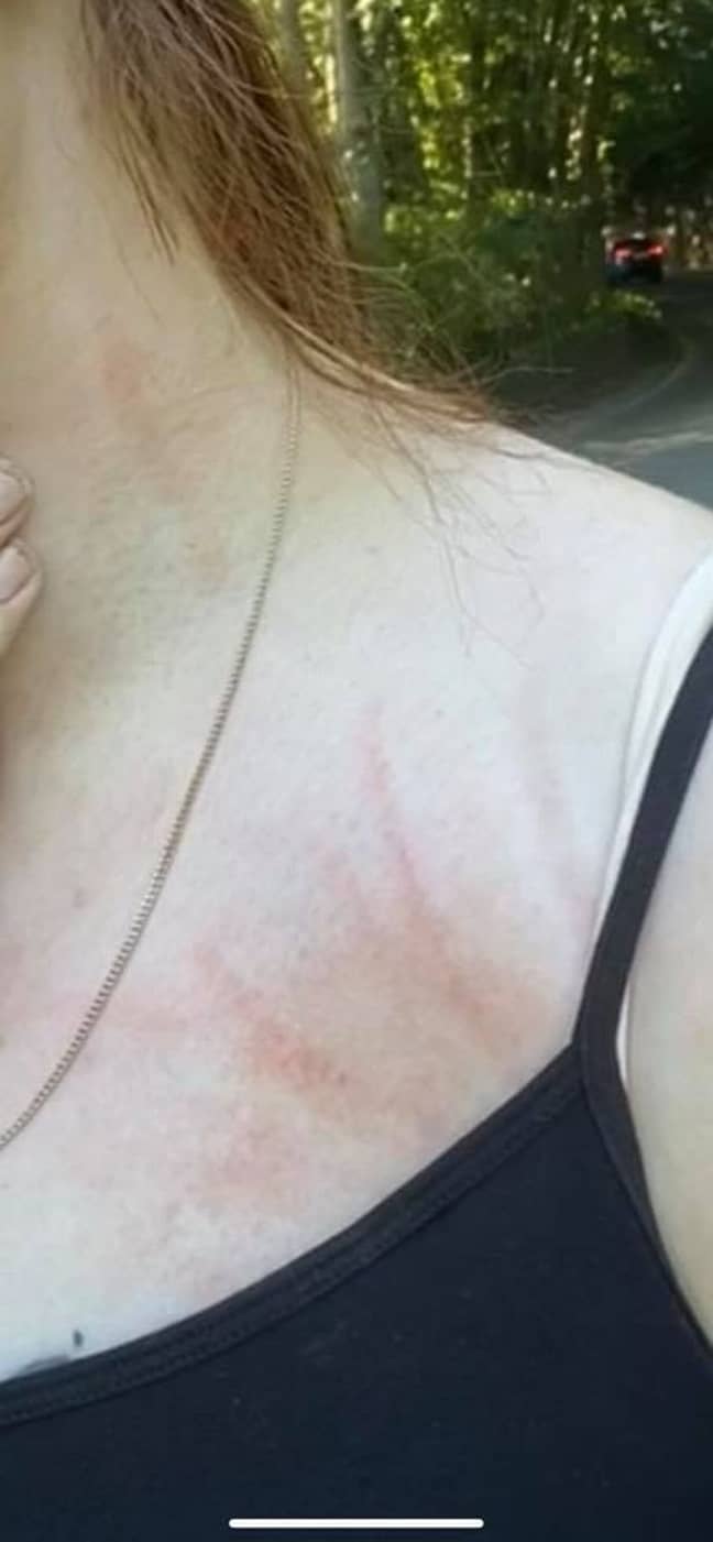 Leah was left with scratches on her neck and face (Credit: Yorkshire Live/MEN Media)