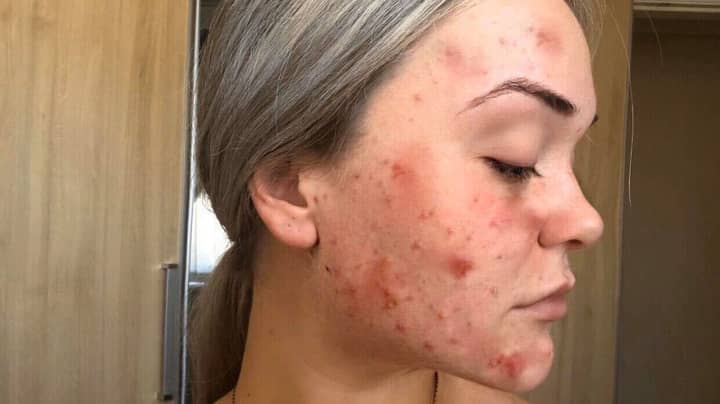 Woman With Chronic Acne Shows Off ‘Life-Changing’ Transformation