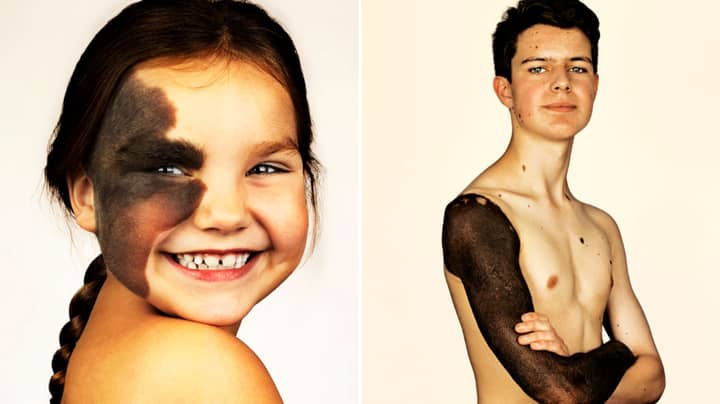 A New Exhibition Has Launched Showcasing People With Rare Skin Conditions