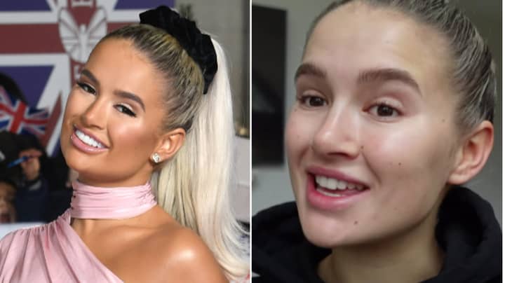 Molly-Mae Reveals Natural Teeth For The First Time As She Continues Reversing Cosmetic Procedures