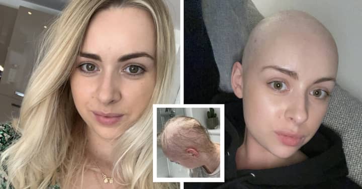  Bride-To-Be 'Traumatised' As Hair Falls Out In Just Six Weeks 