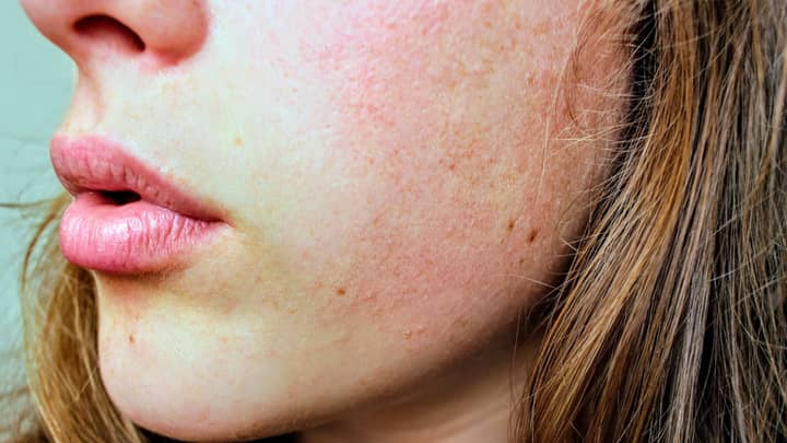 The Mental Health Impact For Acne Sufferers Is Real, Here's How To Tackle It