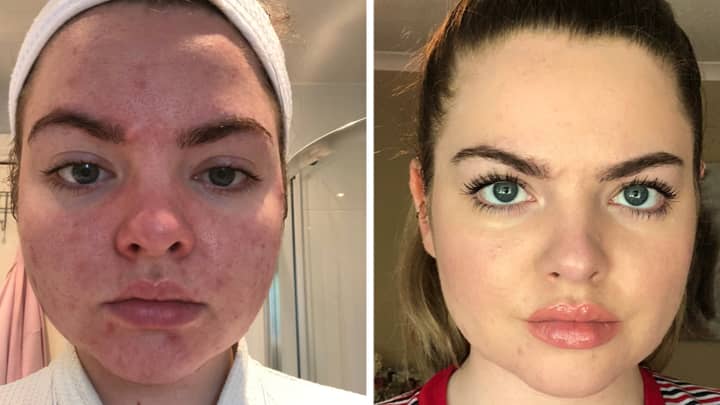 Woman Claims Utan Tanning Water Helped Reduce Her Adult Acne