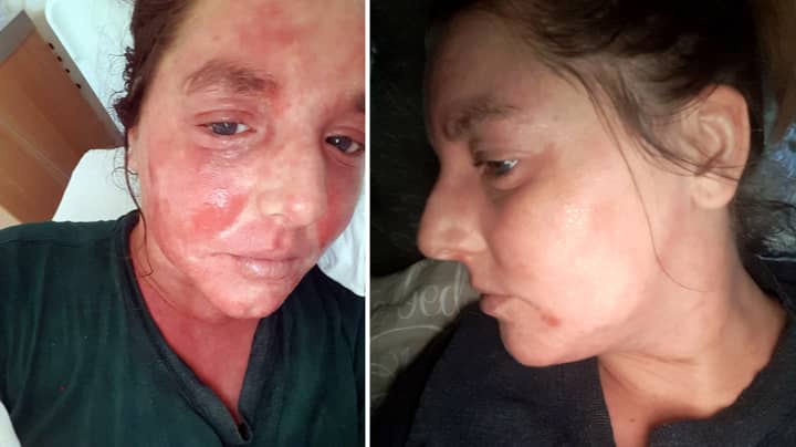 Woman Claims To Have Cleared Up Her Severe Eczema With CBD Oil