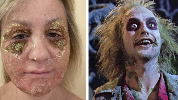 Mum Turns Herself Into 'Beetlejuice' For A Week After Chemical Peel