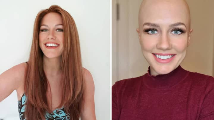 Woman Ghosted By Her Date After Revealing She Has Alopecia