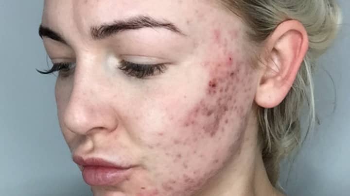 Woman Reveals How She 'Saved' Her Skin Following Five-Year Battle With Acne