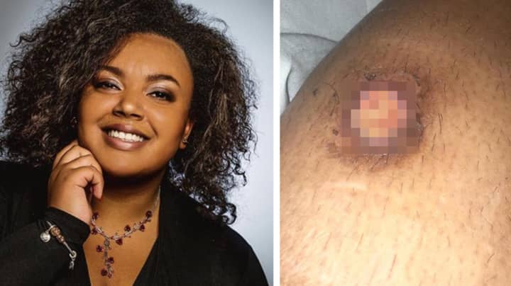 Woman Left With Third Degree Burns After Dropping Common Nail Glue On Her Leg