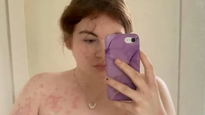 Student Left Hospitalised With Rash After Moving Into Mouldy University Of Leicester Halls Of Residence
