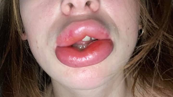 Woman's Lips Triple In Size After Botched £80 Fillers